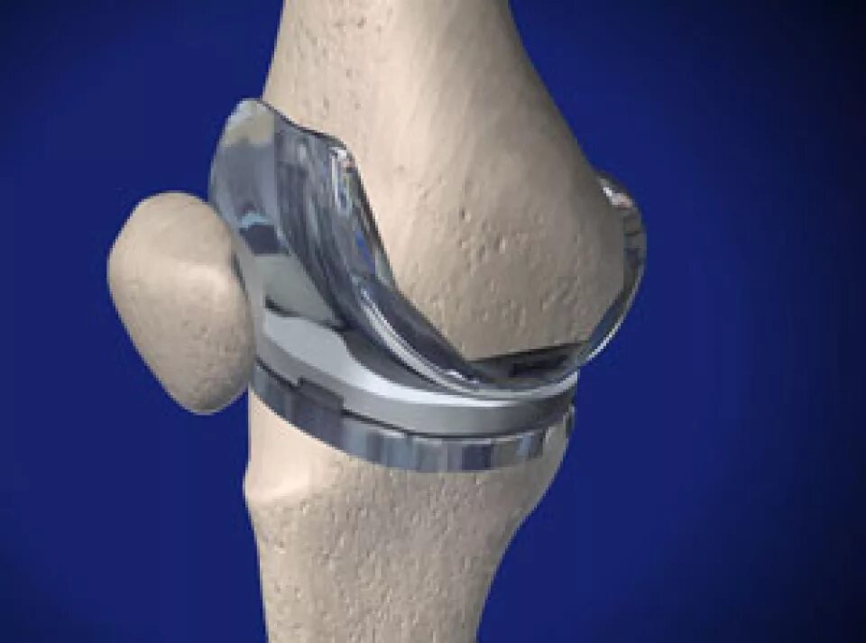 Артропластика коленного сустава. Гемиэпифизиодез коленного сустава.