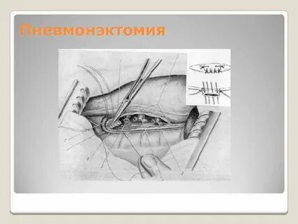 Пульмонэктомия