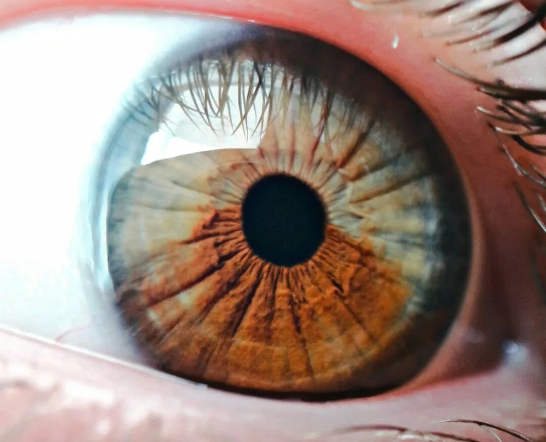 Гетерохромия радужной оболочки. Кольцо вокруг Радужки глаза. Радужная оболочка глаза.