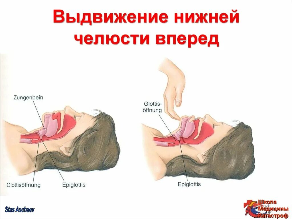 Выдвижение вперед. Способы выдвижения нижней челюсти вперед. выдвижение нижней челюсти. выдвижение нижней челюсти без запрокидывания головы. выдвигание нижней челюсти вперед.
