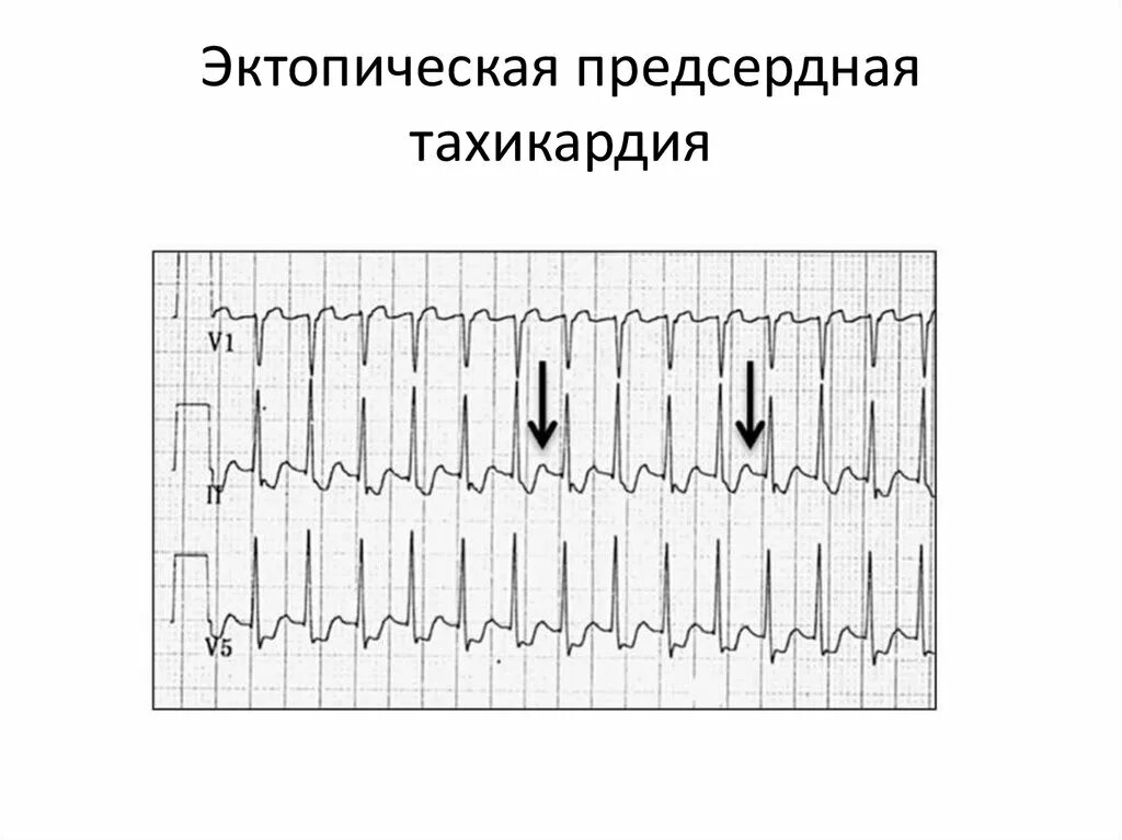 Фокусная предсердная тахикардия. Фокусная предсердная тахикардия экг. Суправентрикулярная тахикардия экг. Предсердная тахикардия. Фокусная эктопическая предсердная тахикардия экг.