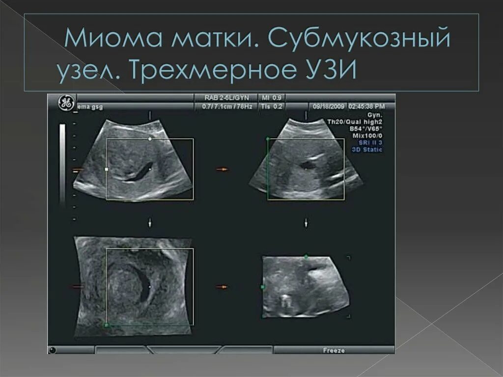 Некроз миоматозного узла на УЗИ. Субмукозная миома матки УЗИ. Узи при миоме матки на какой день