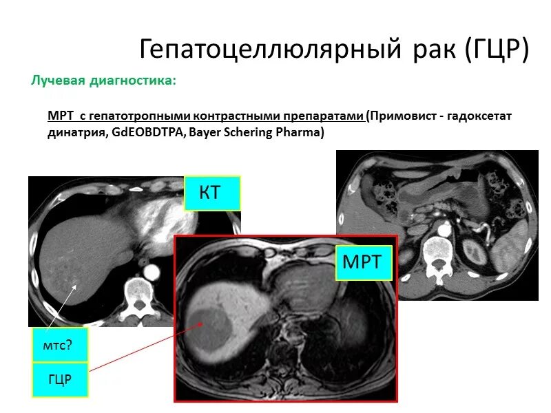 Метастазы в печени 4 стадия сколько живут. Гепатоцеллюлярная карцинома кт. Гепатоцеллюлярная карцинома печени мрт.