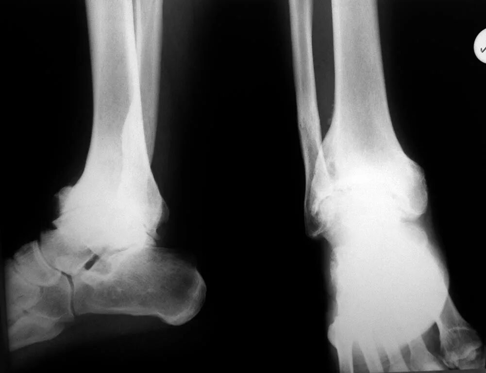 отзывы после артродеза голеностопного сустава