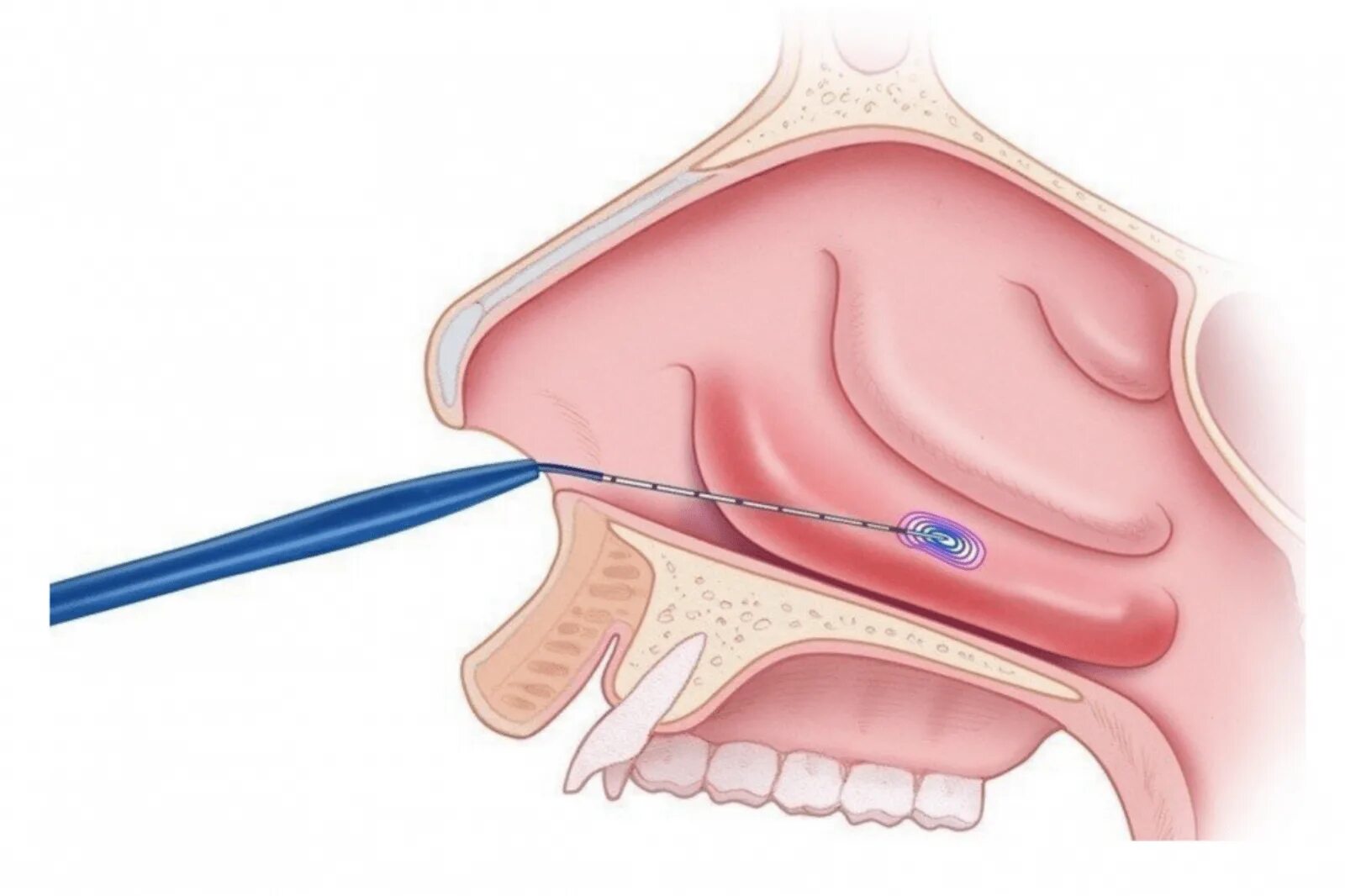 ЛОР операция вазотомия. Гипертрофический ринит ринит. Конхотомия нижних носовых раковин. Радиоволновая конхотомия. Нос в другую сторону