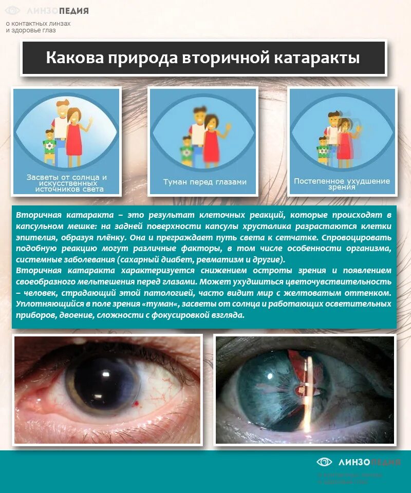 Ограничения при замене хрусталика при катаракте. Памятка при катаракте. вторичная катаракта профилактика. катаракта первичная и вторичная что это такое.