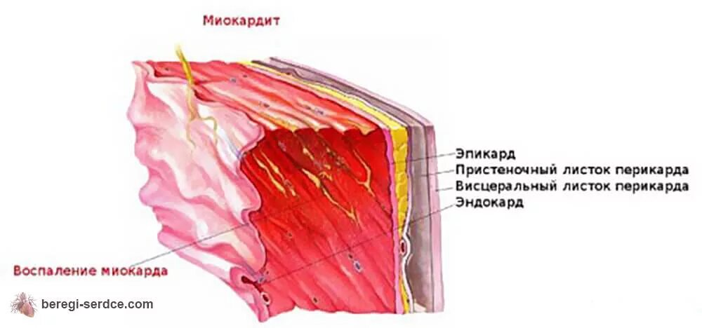 Нарушения сердечной мышцы. Воспаление миокарда миокардит. воспаление сердечной мышцы. расширение границ сердца при миокардите. воспаление миокарда и эндокарда.