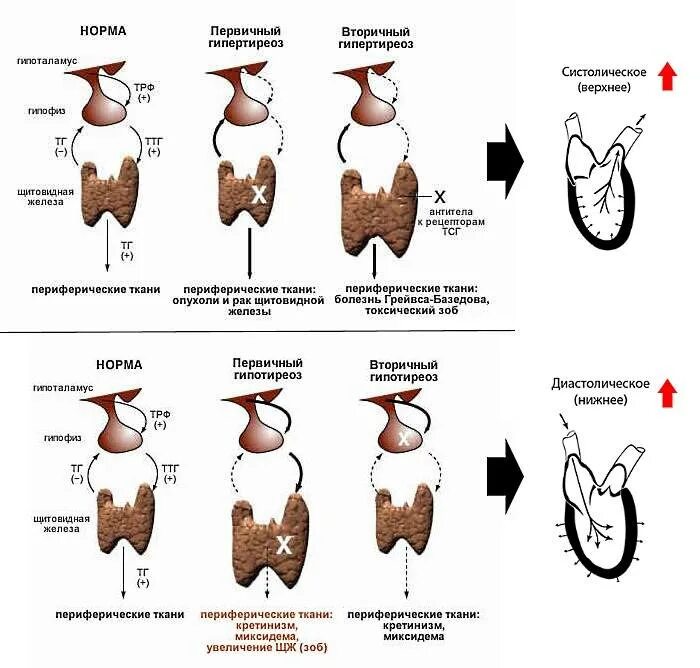 Психосоматика узлов щитовидной железы. Гиперфункция щитовидной железы схема. Гипотиреоз размер щитовидной железы. Первичный вторичный и третичный гипертиреоз. Психосоматика тиреотоксикоза щитовидной железы.