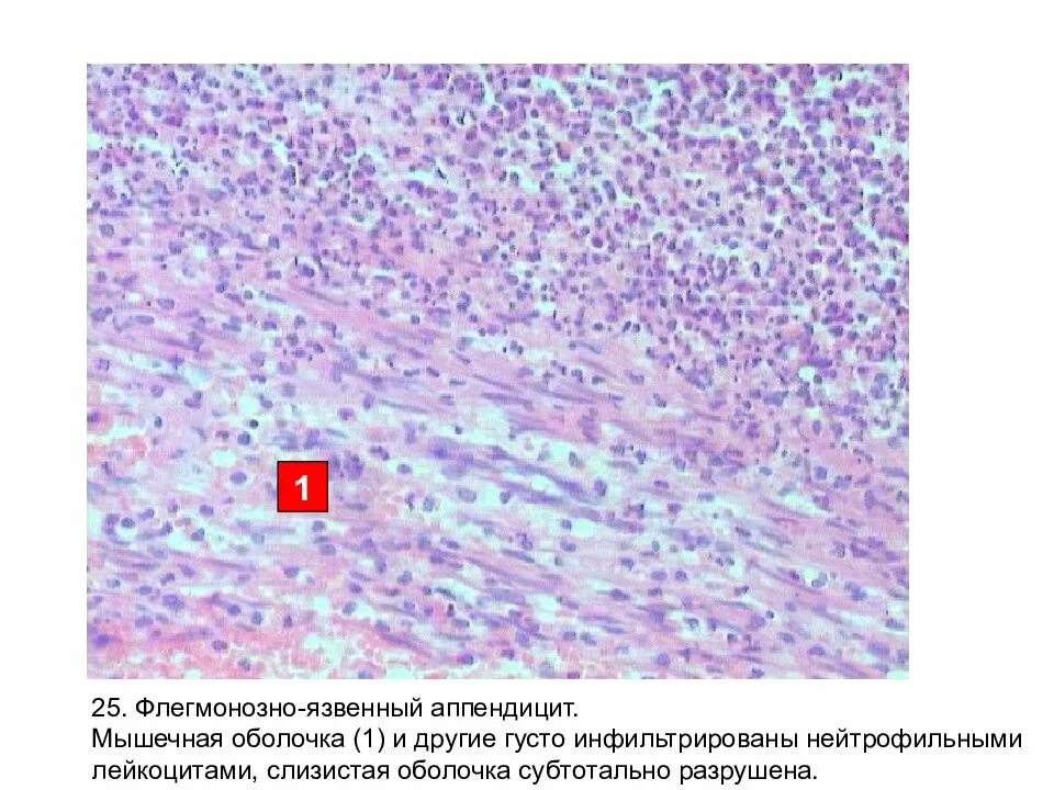 Аппендицит патанатомия. Аппендицит острый патанатомия микропрепарат. Флегмонозно язвенный холецистит микропрепарат. Гнойный флегмонозный аппендицит микропрепарат. Флегмонозно язвенный аппендицит препарат.