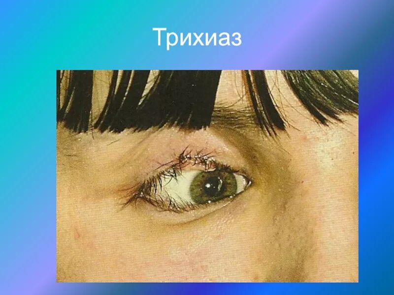 Деформация век. Энтропион и трихиаз века.