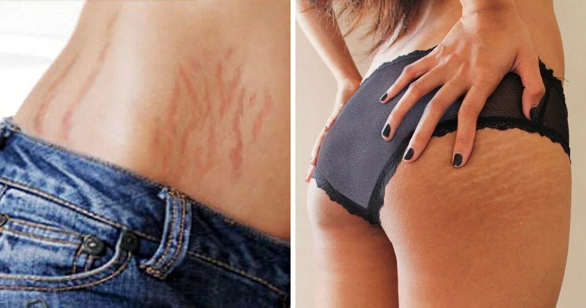 Растяжки stretch marks. Растяжки на теле красные.