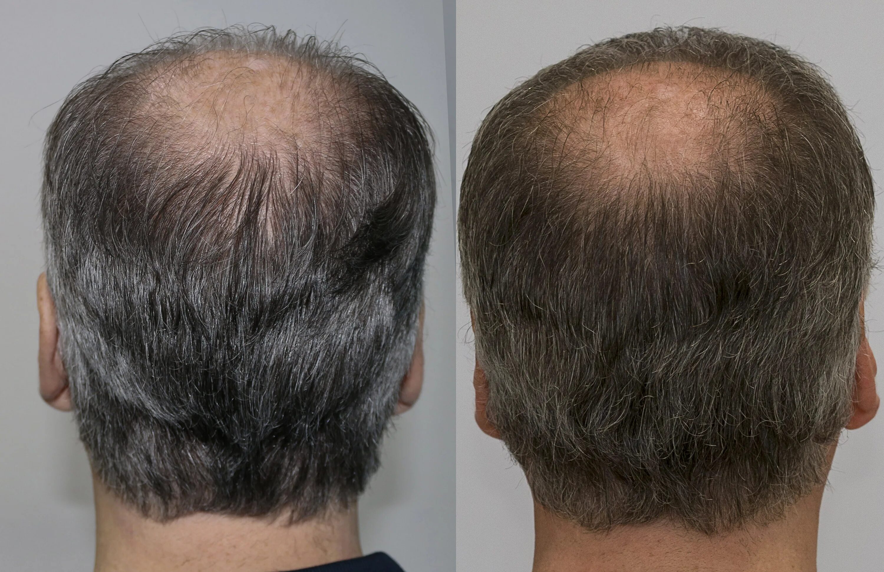 Пересадка волос цена для мужчин 2024. Трансплантация волос на макушке. Трансплантация волос с затылка. Трансплантация волос у мужчин.