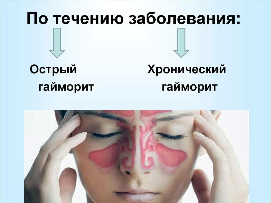 Синусит гайморит фронтит. Острый фронтит острый синусит. Острый верхнечелюстной синусит. Острый и хронический фронтит. Гайморит симптомы чем лечить