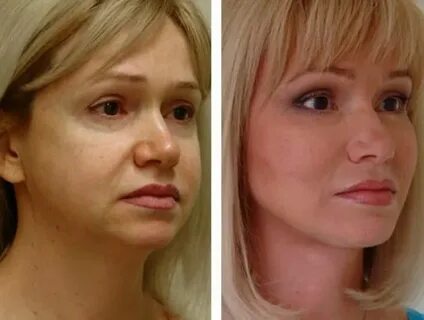 Пластика лица что делают