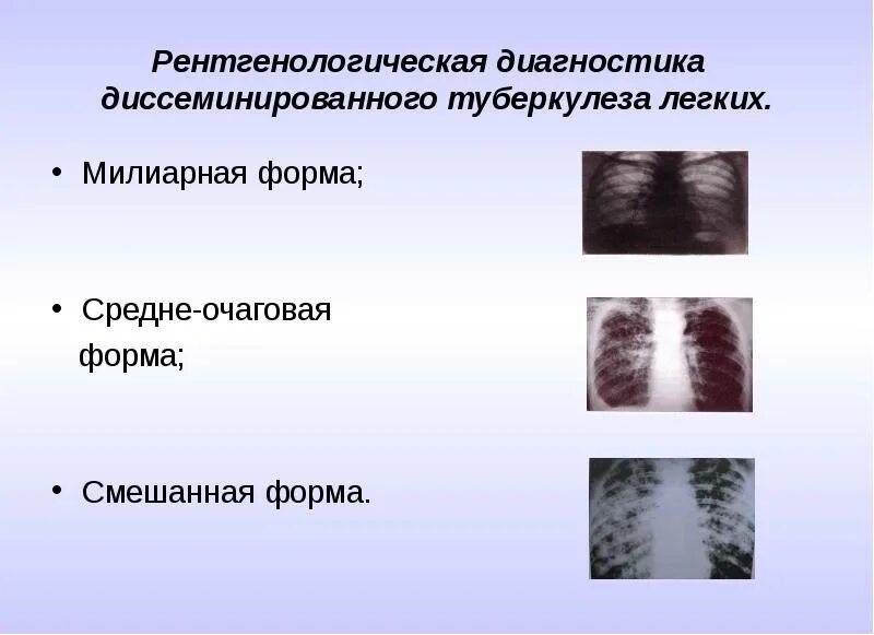 Диссеминированный туберкулез фаза инфильтрации