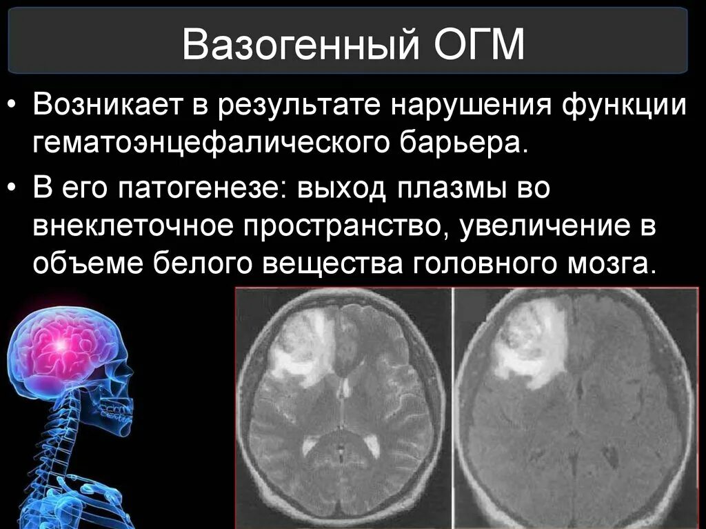 Вазогенный отек головного мозга кт. Механизм развития отека головного мозга. Этиология отека головного мозга.