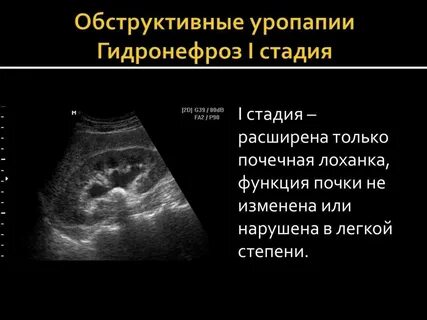 Гидронефроз при беременности
