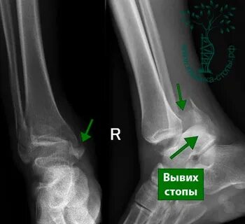 Подвывих сухожилия