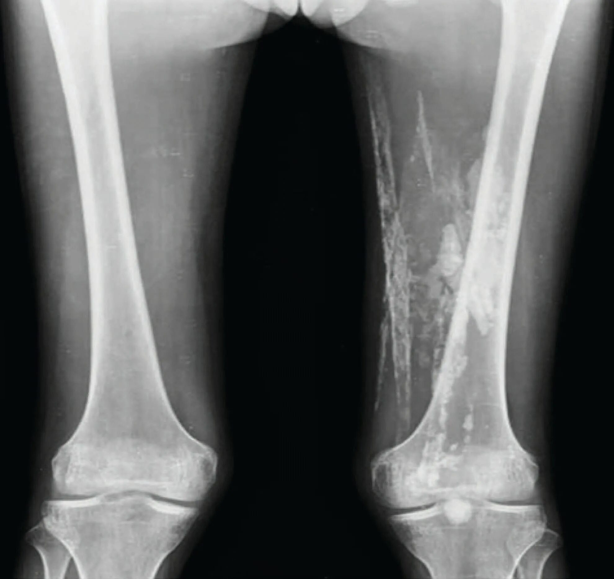 Трещина голени. Рентген большеберцовой кости норма. Большеберцовая кость рентген. Рентген берцовой кости. Перелом берцовой кости рентген.