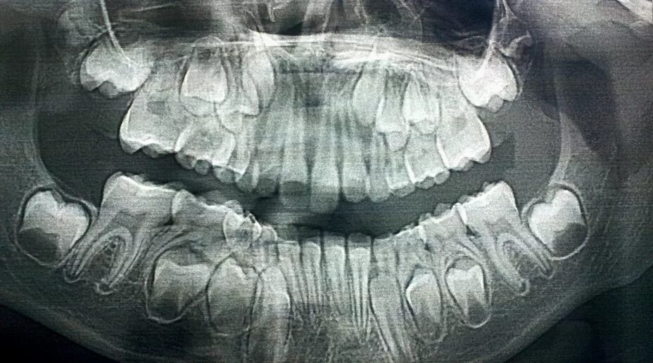 Детский череп фото. Рентген молочных зубов. Снимок ребенка с молочными зубами. Снимок черепа ребенка с зубами.