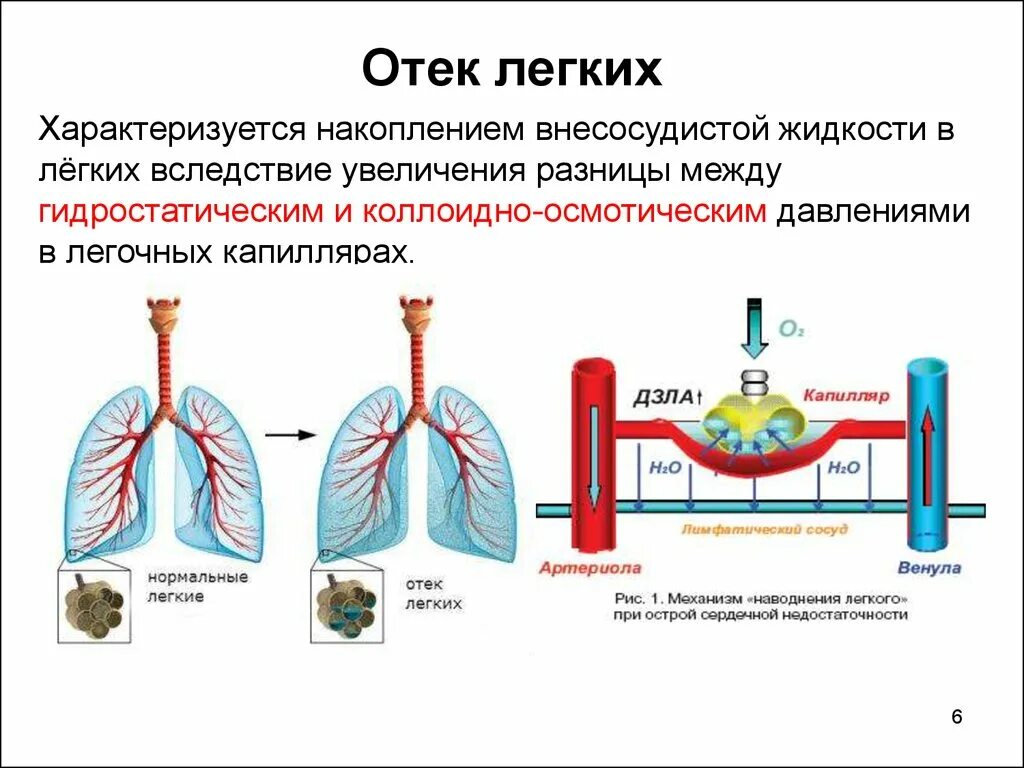 Гидростатический отёк лёгких.