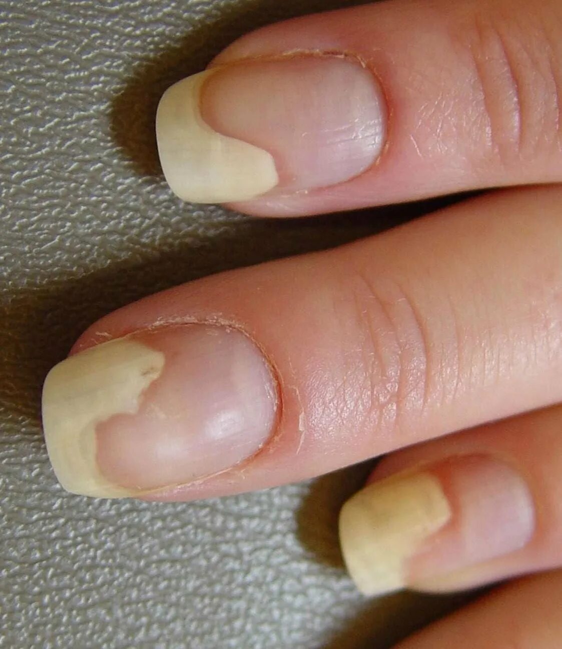 Почему отваливаются ногти гель. Ониходистрофия - онихолизис.. Онихолизис ногтей онихолизис.
