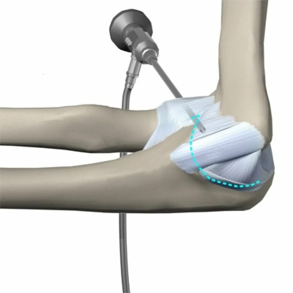 Артроскопическая терапия эпикондилита локтевого сустава. Артрогенная контрактура локтевого сустава. Тугоподвижность локтевого сустава. Артроскопия коленной связки. Контрактура сустава после перелома