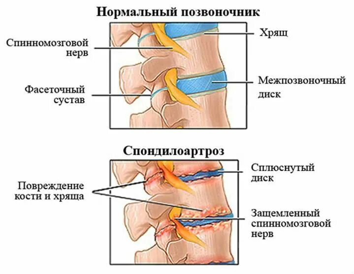 Деформирующий спондилоартроз на уровне. Спондилоартроз пояснично-крестцового отдела. спондилоартроз пояснично-крестцового отдела позвоночника l1-s1. спондилоартроз поясничного отдела позвоночника что это такое. остеохондроз спондилоартроз поясничного отдела.