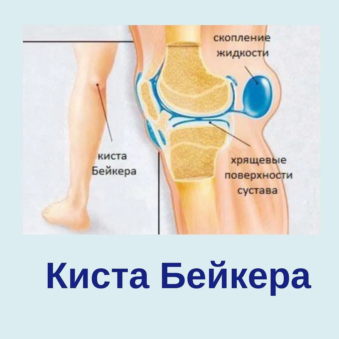 Синовиальная жидкость в суставах. Жидкость в коленной чашечке. Супрапателлярный бурсит. Препателлярный бурсит. Препателлярный бурсит.