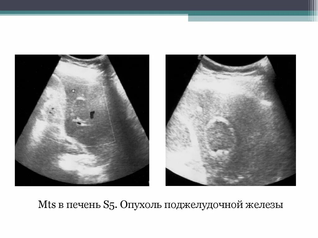 Множественные образования в печени. Образования печени на УЗИ. Объемные образования печени (МТС).