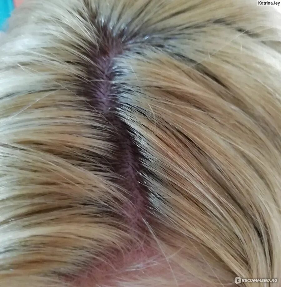 Ожог на голове после обесцвечивания волос. Болячки на голове от обесцвечивания. Желтые волосы после обесцвечивания. Кожа головы после обесцвечивания. Порошок для обесцвечивания волос.