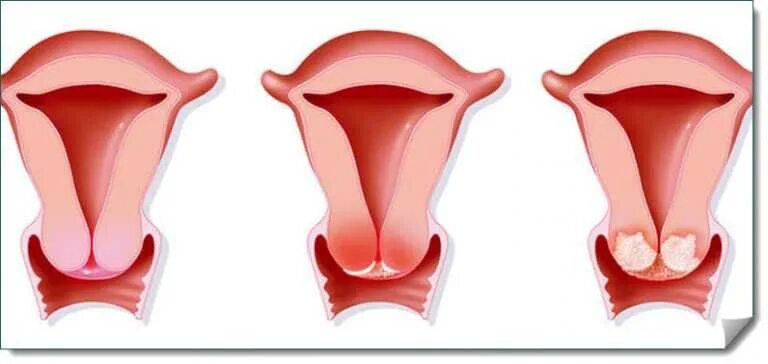 Компонент эндоцервикса и зоны. Эндоцервикоз цервицит. Эндоцервикоз и эндоцервицит. Эндоцервикоз шейки матки что это.