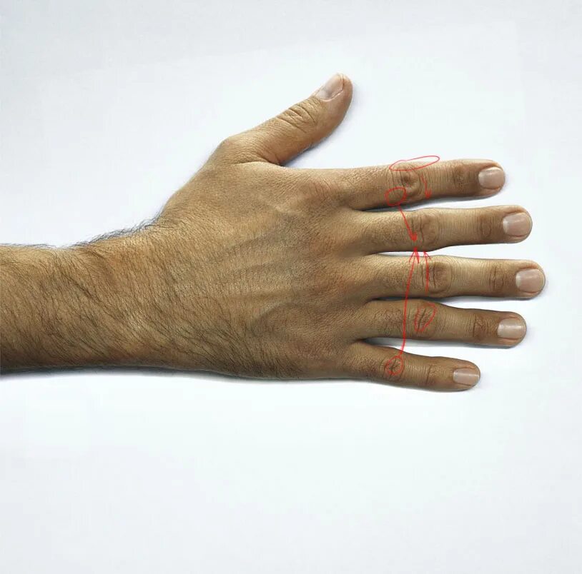 На 1 руке 6 пальцев. Полидактилия шестипалость. Мужская кисть руки.