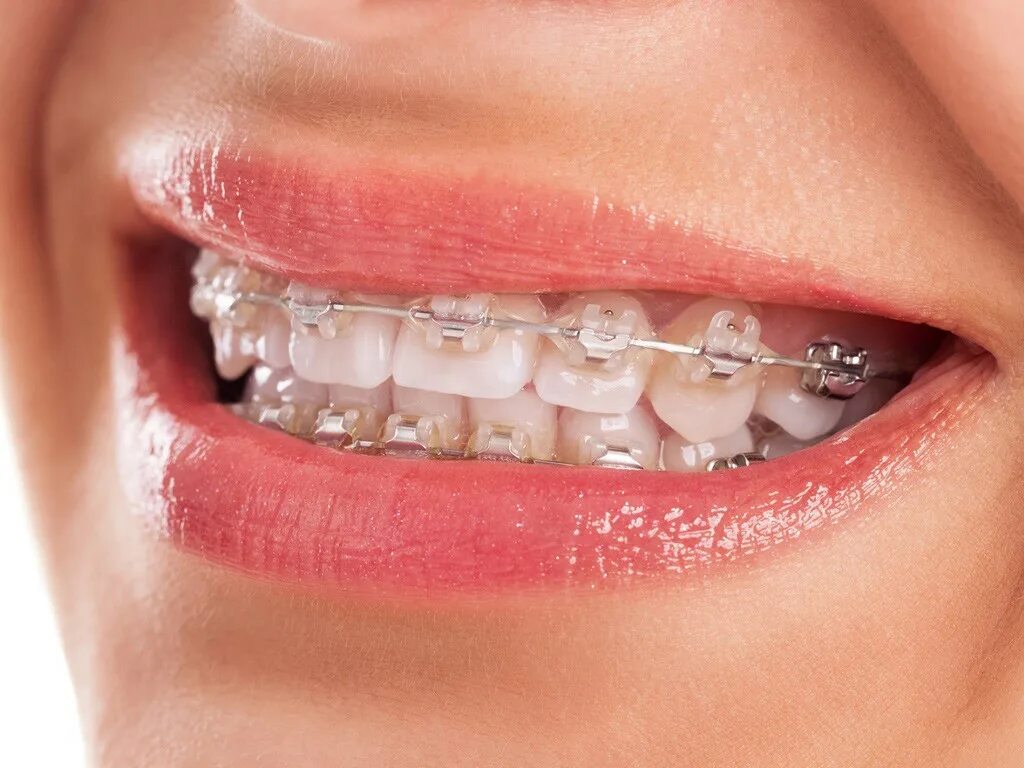 Металлические лигатурные брекеты mini diamond. American orthodontics брекеты самолигирующие. Брекеты на зубы ортодонтия. Самолигирующие лингвальные брекеты. Изготовление брекетов.