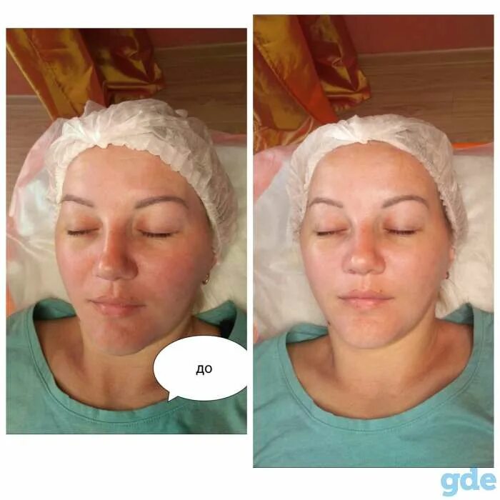 Озонотерапия для волос. Карбокситерапия для лица до и после. Карбокси пилинг. Неинвазивная карбокситерапия. Premium набор для лица и шеи peeling carboxy therapy.