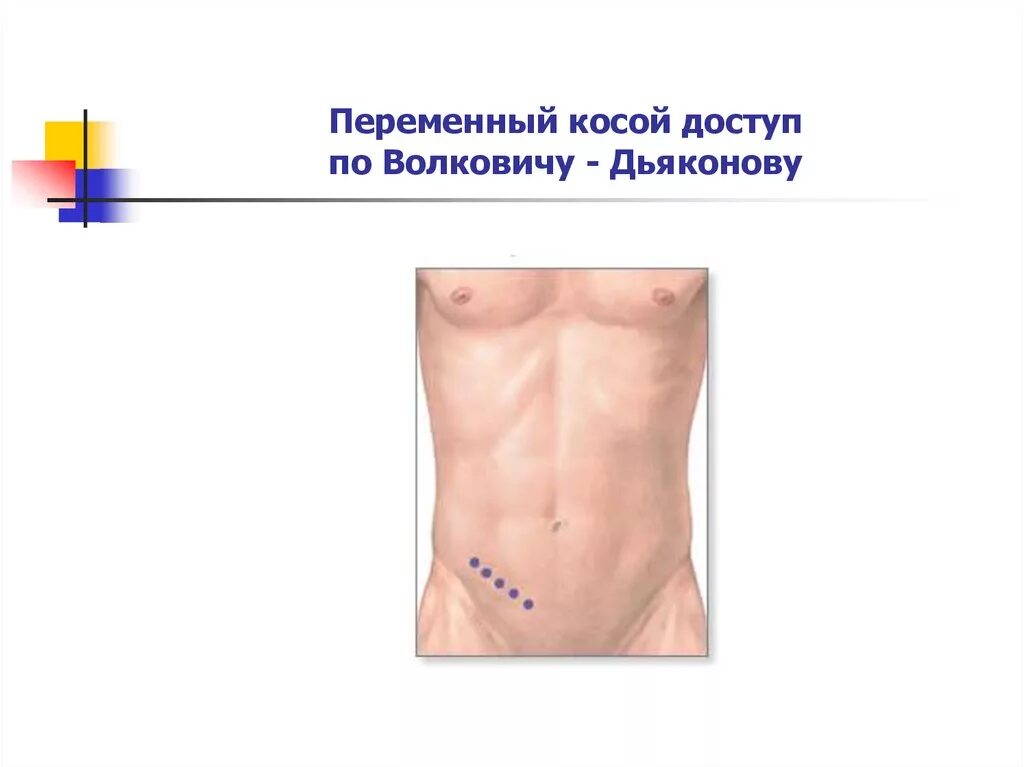 Точки аппендицита. Разрез Мак Бурнея Волковича Дьяконова. Лапаротомия доступом Волковича-Дьяконова. Протокол диагностической лапаротомии. Косой переменный разрез Волковича-Дьяконова.