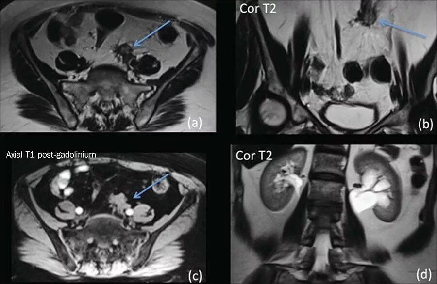 Видны ли на мрт. Мрт пояснично-крестцового отдела позвоночника нервы. Внутрисуставной перелом коленного сустава мрт. Миелопатия спинного мозга шейного отдела мрт. Межпозвонковые корешки мрт.