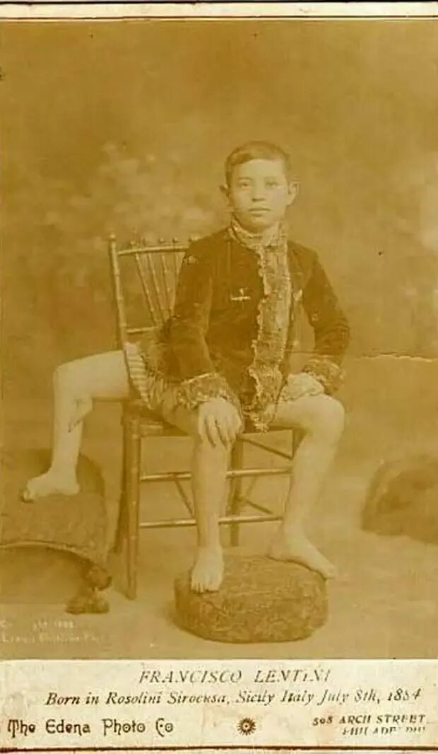 Видит три ноги. Франческо Лентини. Франческо Лентини человек с тремя ногами.1889. Трёхногий Фрэнк Лентини. Франческо Лентини фото.