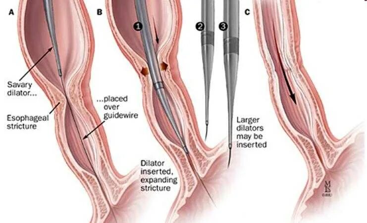 Бужирование стриктуры пищевода. Стеноз пищевода - бужирование пищевода. Эндоскопическая баллонная дилатация пищевода. Эндоскопическое бужирование стриктур пищевода. Стеноз прямой