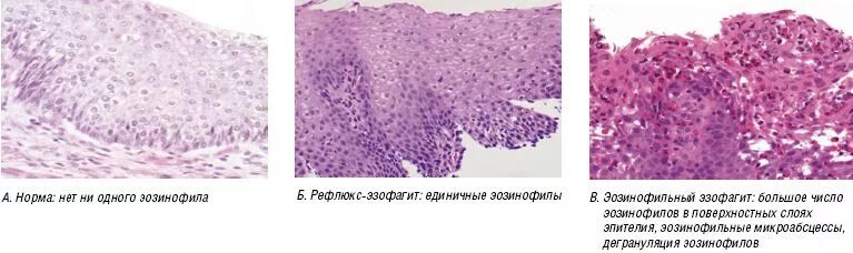Эозинофильный гастрит гистология. Эозинофильный эзофагит гистология. Катаральный эзофагит патанатомия.