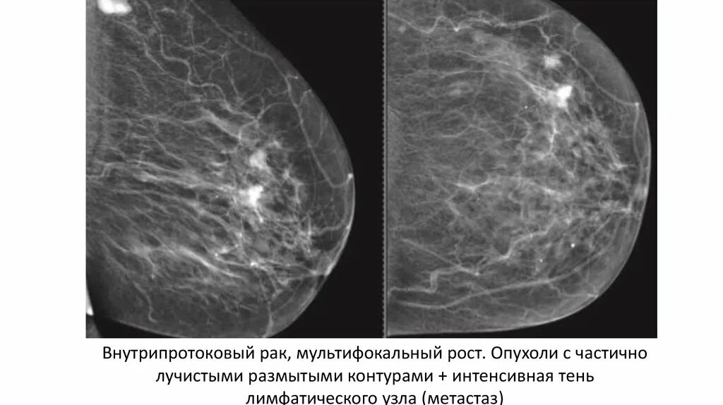 Метастазы в лимфоузлах молочной железы. Мультифокальный рост опухоли молочной железы. метастазы в молочной железе на маммографии. маммография молочных желез объемное образование. внутрипротоковая карцинома маммография.