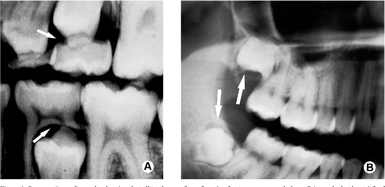 Рентгеновские снимки молочных зубов. Рентген молочных и коренных зубов. Смена молочных зубов рентген.
