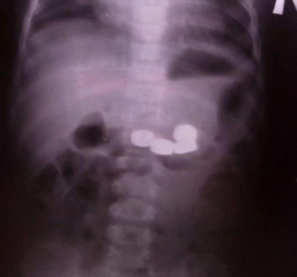 Проглотил через сколько выйдет. Рентген инородное тело в ЖКТ. Инородное тело батарейка. Монета в желудке у ребенка на рентгене. Инородные тела пищеварительного тракта рентген.