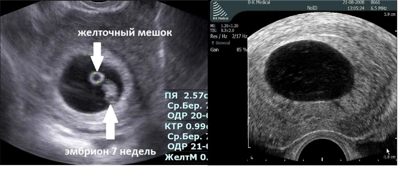 Снимок УЗИ пустого плодного яйца. Плодное яйцо с эмбрионом и желточным мешком. УЗИ неразвивающейся беременности 6 недель. Почему не видно эмбрион