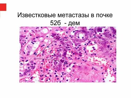 Паренхиматозные дистрофии патанатомия