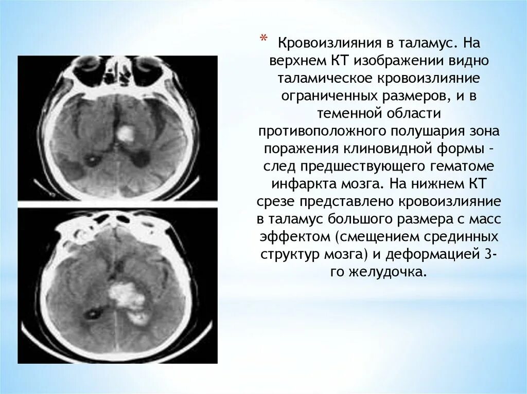 Кровоизлияние ствола мозга. Геморрагический инсульт паренхиматозное кровоизлияние клиника. Геморрагический инсульт кт. Кровоизлияние в таламус на кт. Таламическая гематома кт.