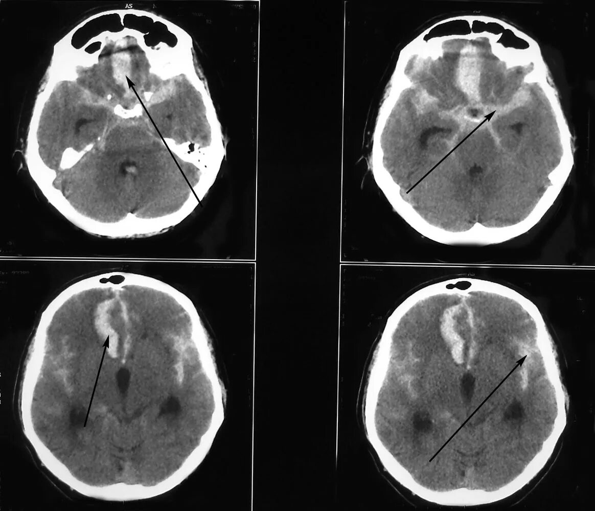 Геморрагический инсульт субарахноидальное кровоизлияние кт. Субарахноидальное кровоизлияние головного мозга на кт. Суарахноидальное кровизлияниект. Сак субарахноидальное кровоизлияние. Травматическое кровоизлияние