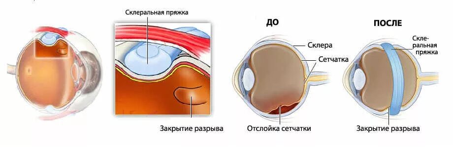 Пломбирование сетчатки глаза. Пломбирование отслойки сетчатки. отслойка сетчатки экстрасклеральное пломбирование. отслойка сетчатки циркляж. склеральное пломбирование сетчатки.