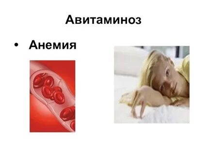 Анемия авитаминоз