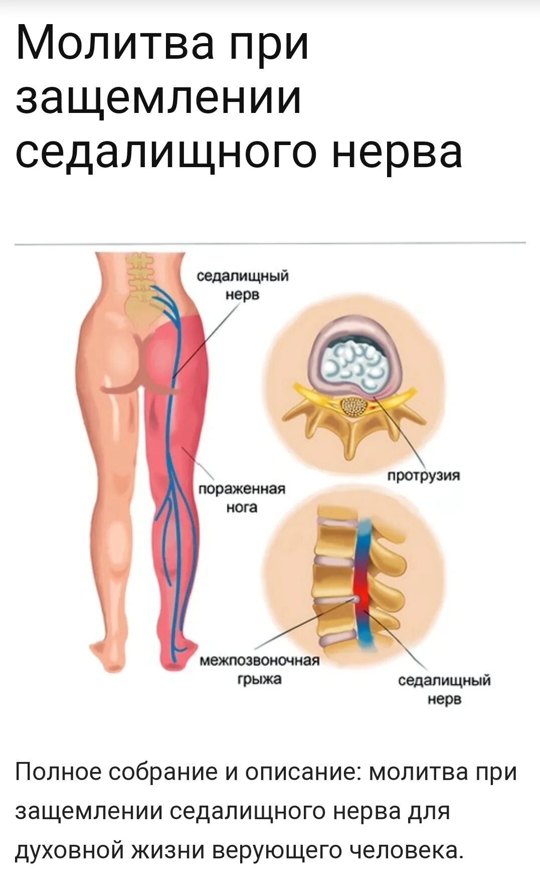 Как лечить защемление в пояснице. Невралгия седалищного нерва. При зажатии седалищного нерва. Лекарство при седалищном нерве. Ущемление седалищного нерва лекарства.